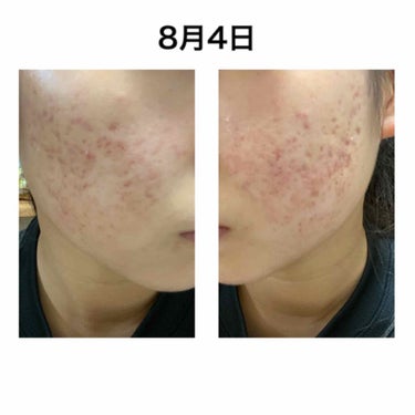 無印良品 敏感肌用薬用美白化粧水・高保湿タイプのクチコミ「お久しぶりです！
肌荒れ系JKです☺️
もう夏本番ですね、日焼け止めの消費量がすんごいです😇
.....」（2枚目）