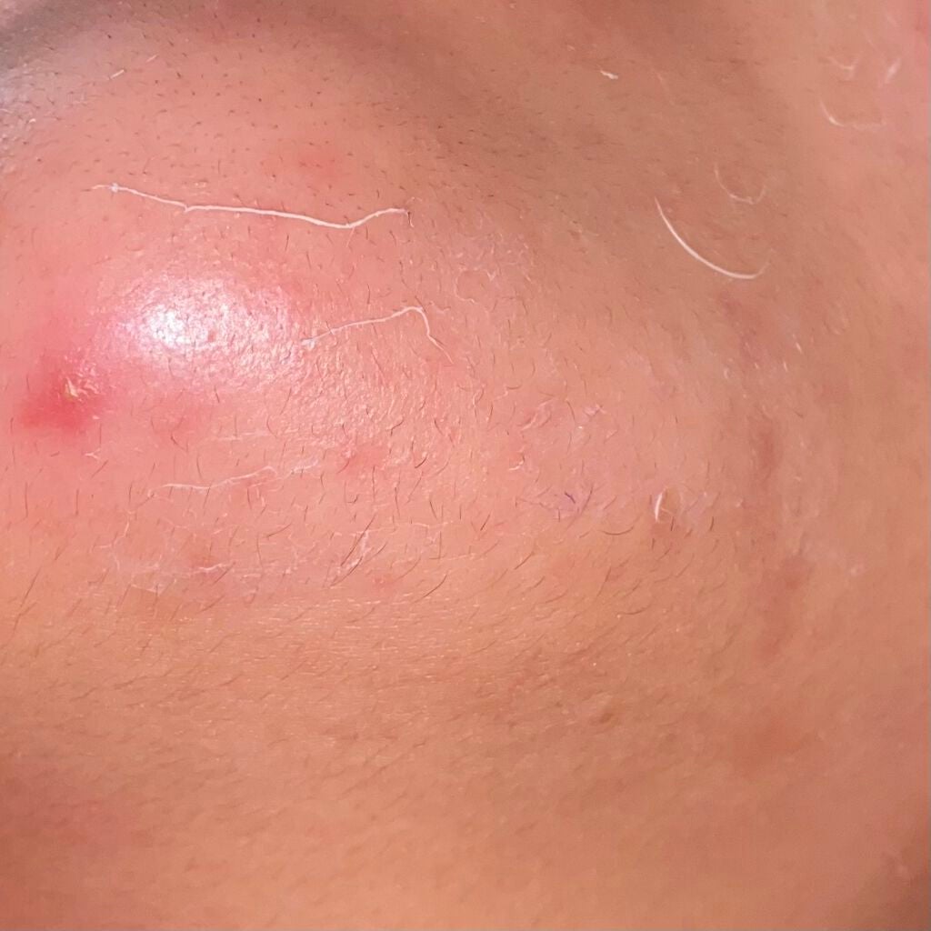 luna on LIPS 「ニキビ撲滅作戦パート2皮膚科でもらった薬を継続して2週間が経過..」(4枚目)