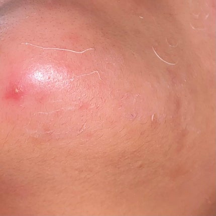 luna on LIPS 「ニキビ撲滅作戦パート2皮膚科でもらった薬を継続して2週間が経過..」(4枚目)