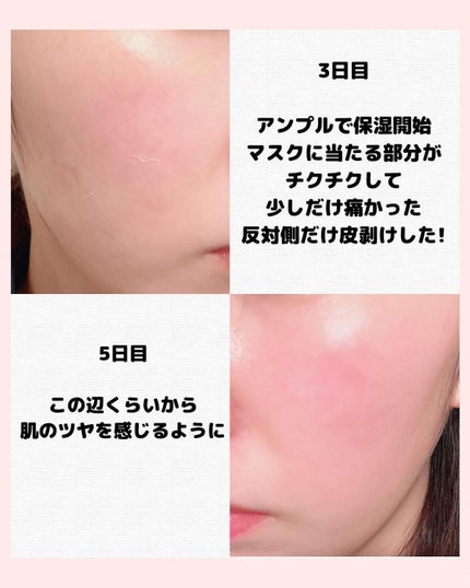 ダーマスキンピーリング/BQCELL/その他キットセットを使ったクチコミ(6枚目)