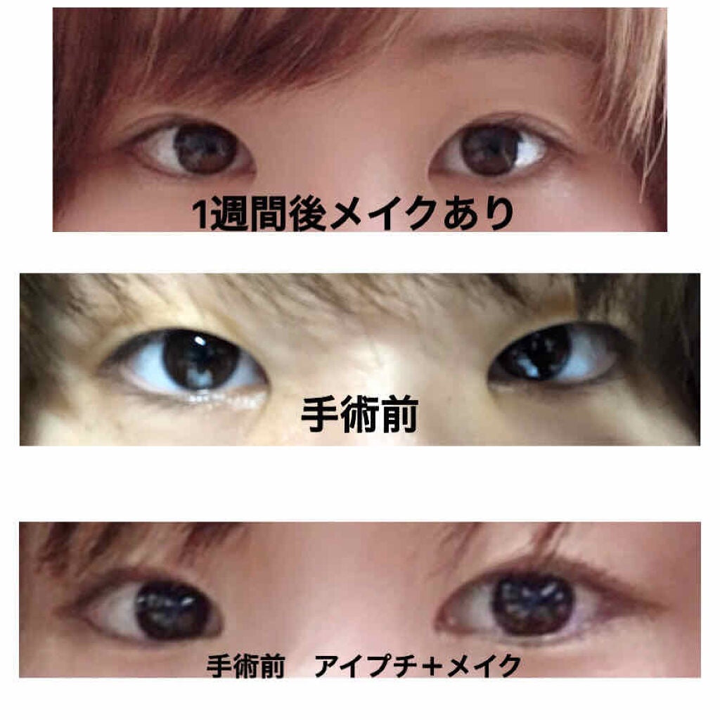 mikoto on LIPS 「二重整形(埋没方法)してきました。私は湘南美容外科でクイックコ..」(4枚目)