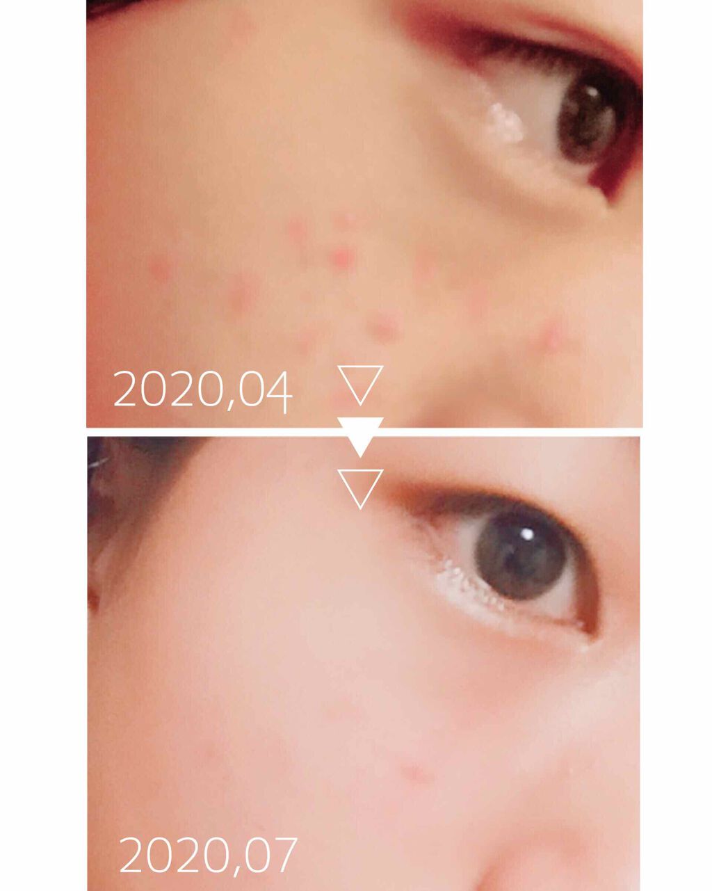 薬用泡のふんわり洗顔/スキンライフ/泡洗顔を使ったクチコミ（2枚目）