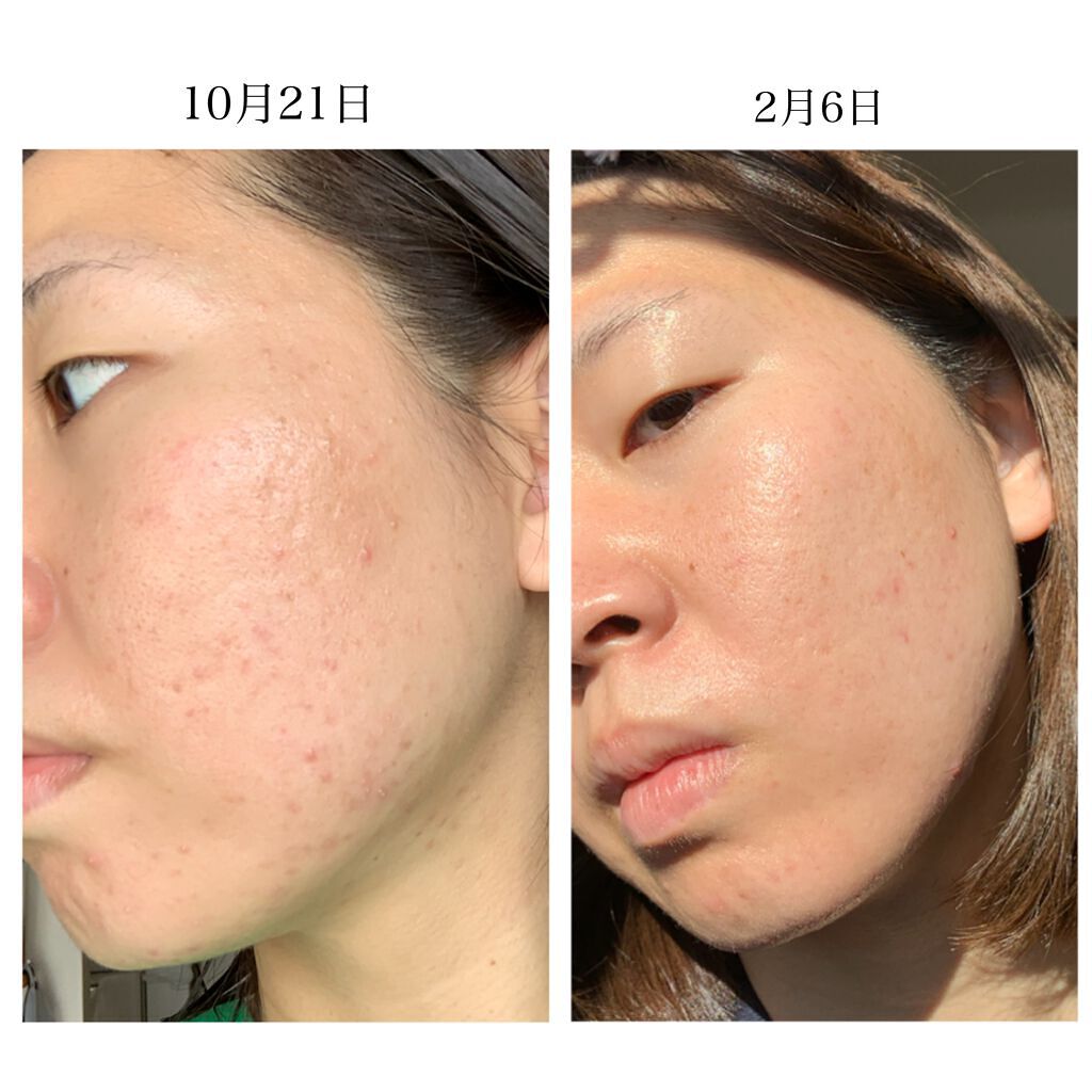 リアルカロテンブレミッシュクリアセラム/APRILSKIN/美容液を使ったクチコミ(6枚目)