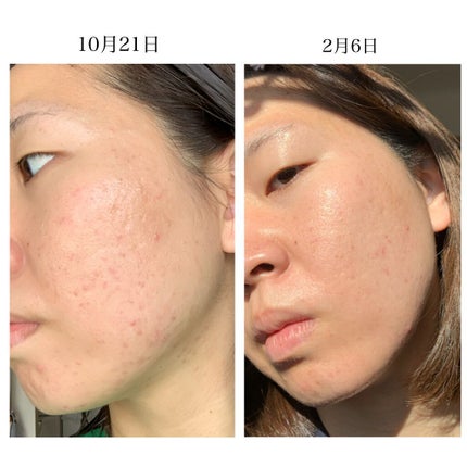 リアルカロテンブレミッシュクリアセラム/APRILSKIN/美容液を使ったクチコミ(6枚目)