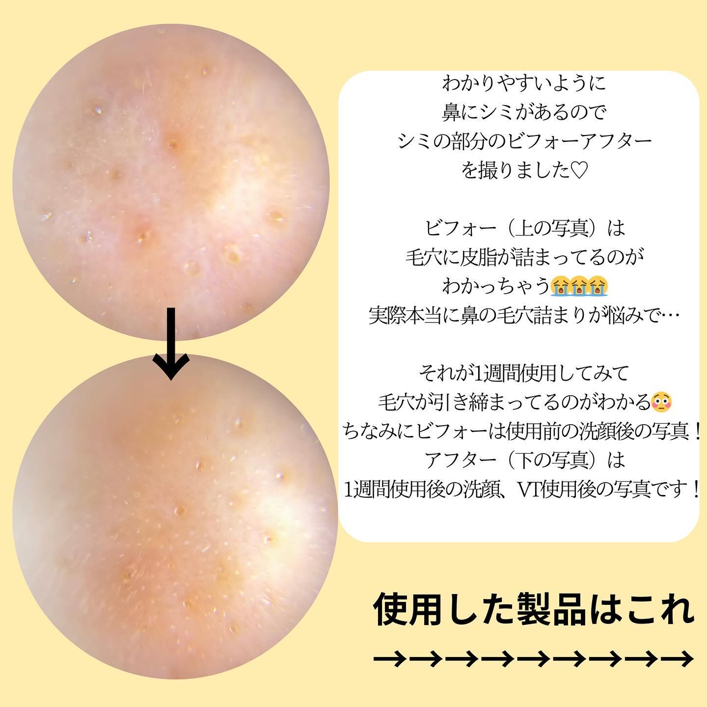 シカレチA エッセンス0.1/VT/美容液を使ったクチコミ（2枚目）