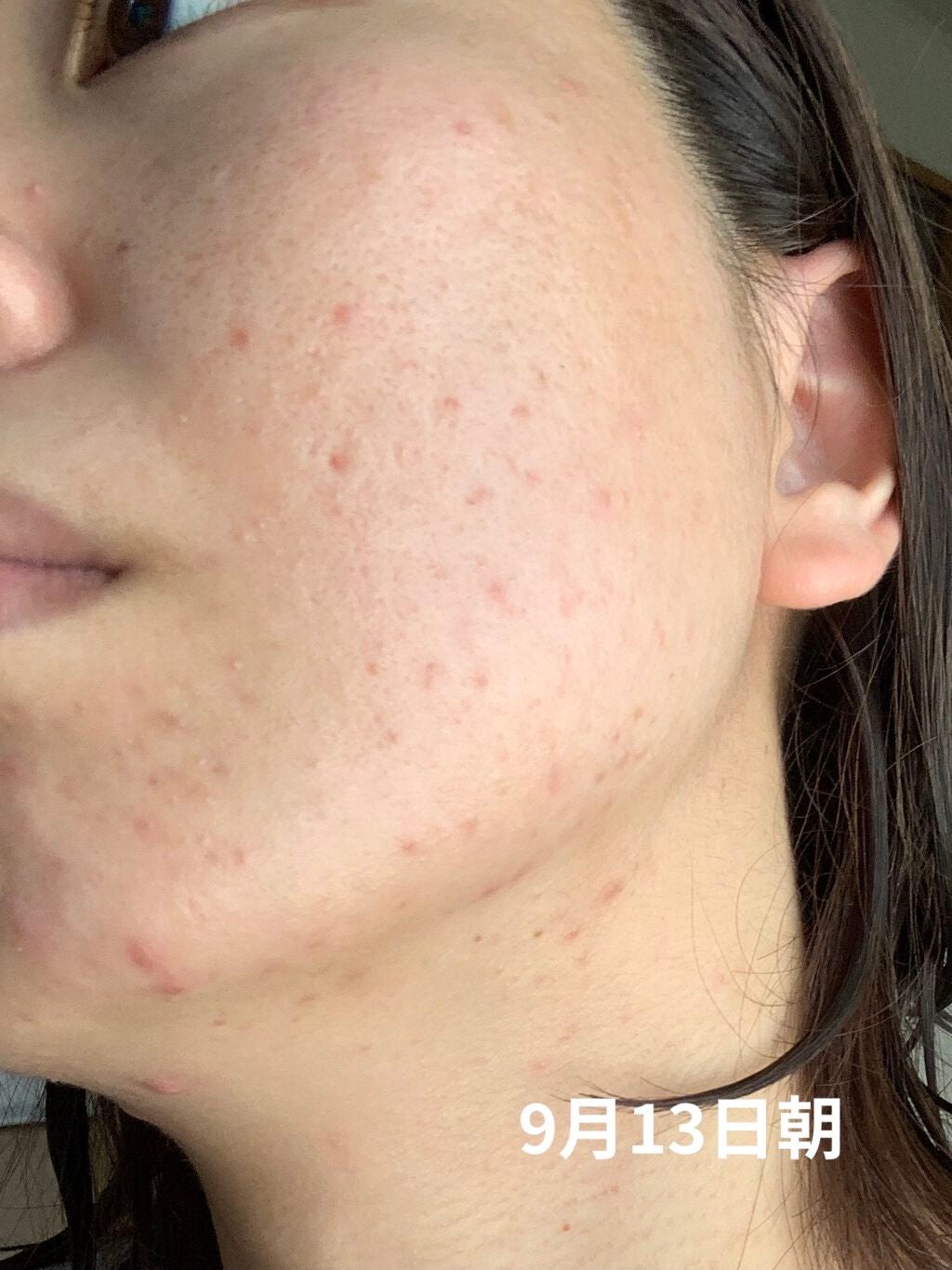 薬用 しみ 集中対策 美容液/メラノCC/美容液を使ったクチコミ(8枚目)