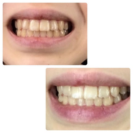 はみがき デイリータイプ/セッチマ/歯磨き粉を使ったクチコミ(2枚目)