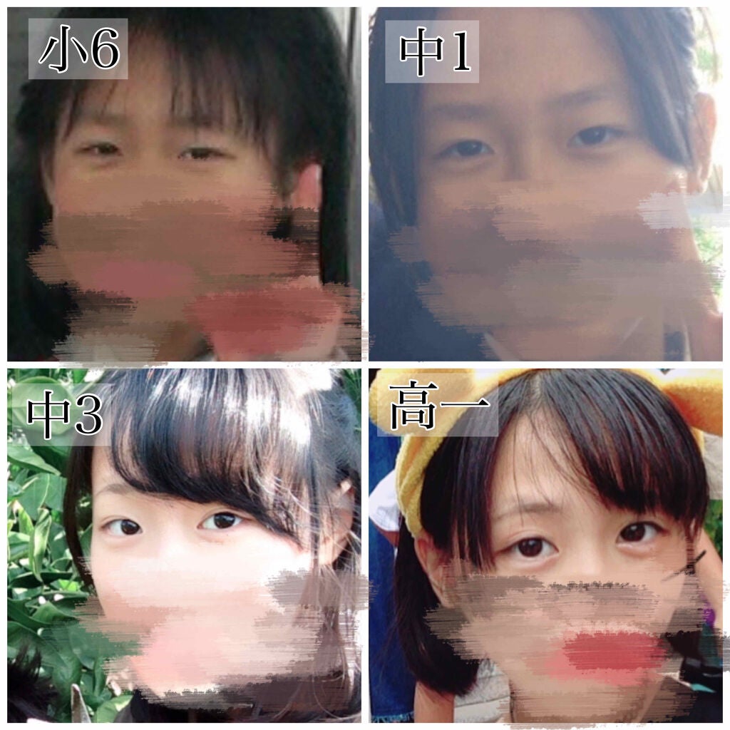 rim on LIPS 「私の二重についてこんにちは!初投稿させて頂きます!私の二重遍歴..」(2枚目)