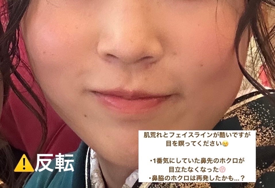 セノ on LIPS 「ほくろ取りして3ヶ月経ちましたので経過報告です!日焼けに注意し..」(4枚目)