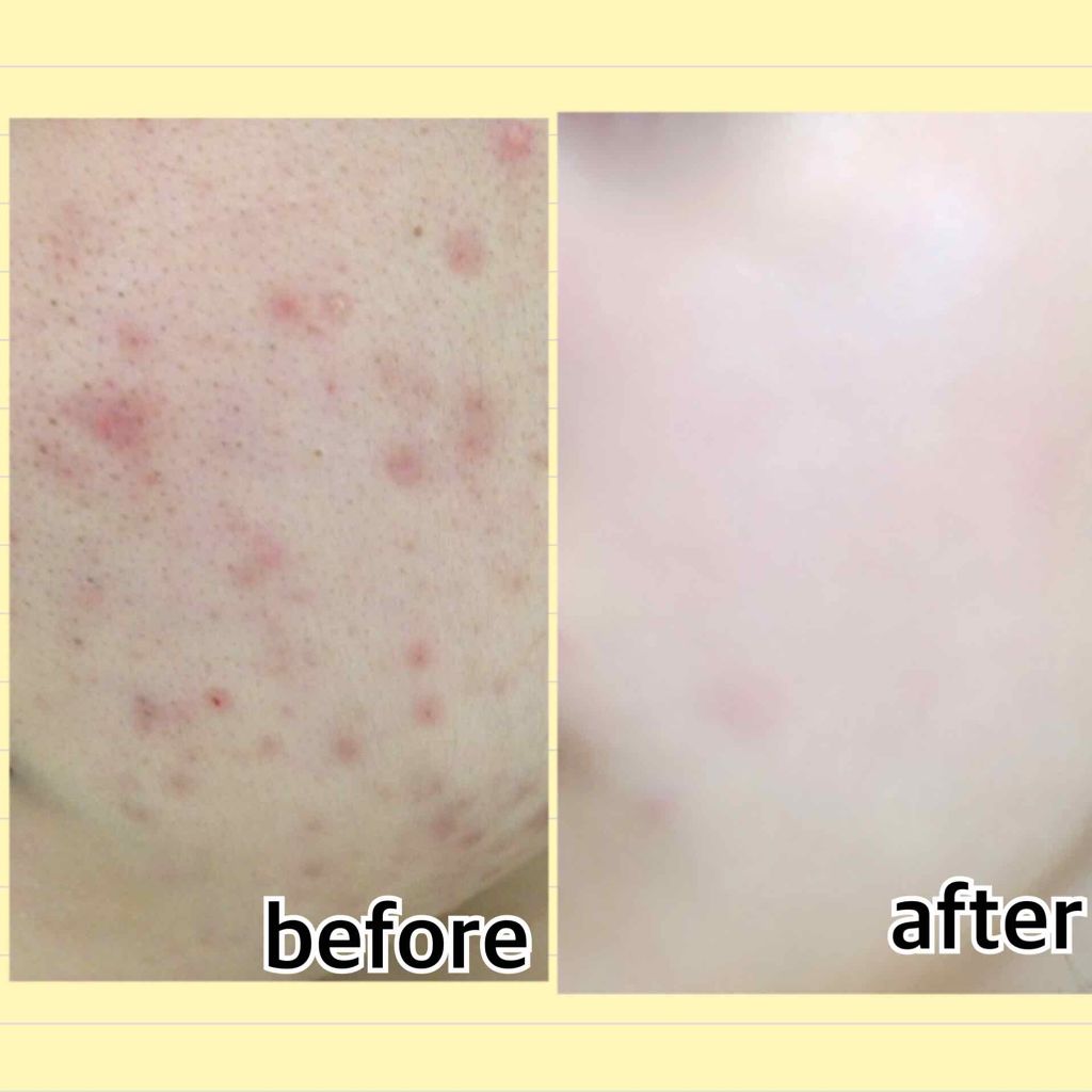 オードムーゲ 薬用ローション(ふきとり化粧水)/オードムーゲ/拭き取り化粧水を使ったクチコミ(4枚目)