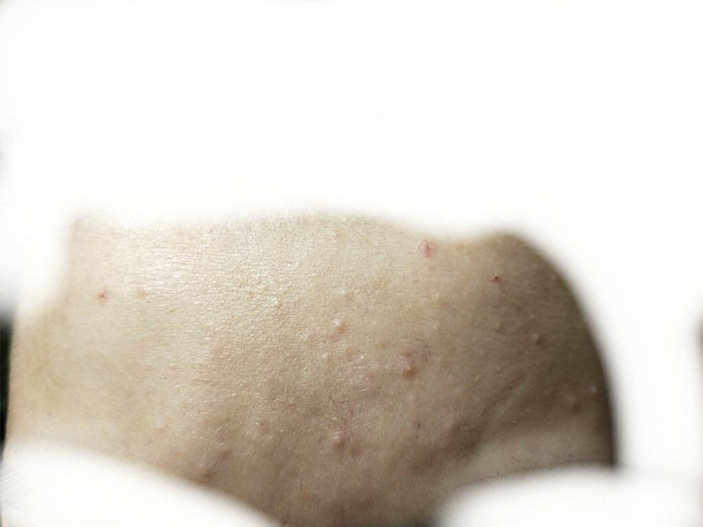 薬用アクネピールエッセンス/プレビュート/ピーリングを使ったクチコミ（1枚目）