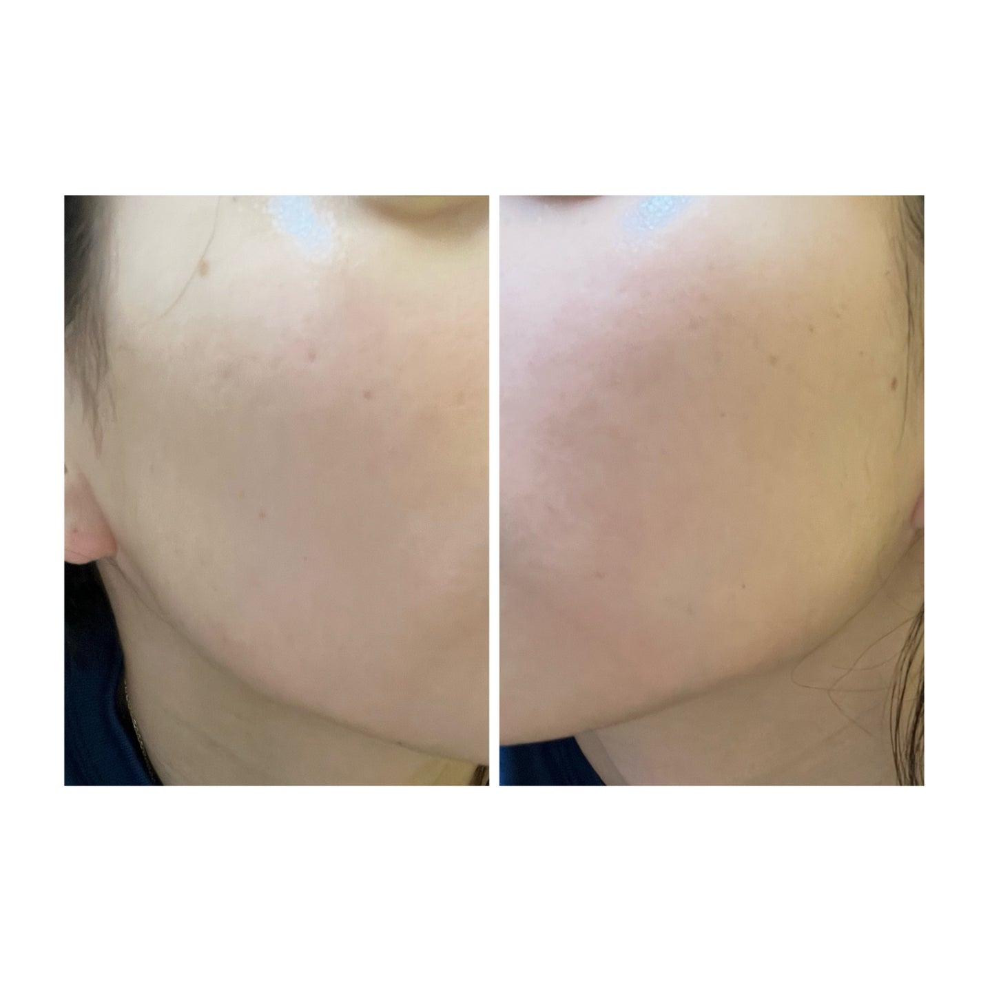 ぽむ on LIPS 「2023.9.13皮膚科に受診 エピデュオとヘパリン処方1枚目..」(5枚目)