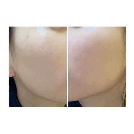 ぽむ on LIPS 「2023.9.13皮膚科に受診 エピデュオとヘパリン処方1枚目..」(5枚目)