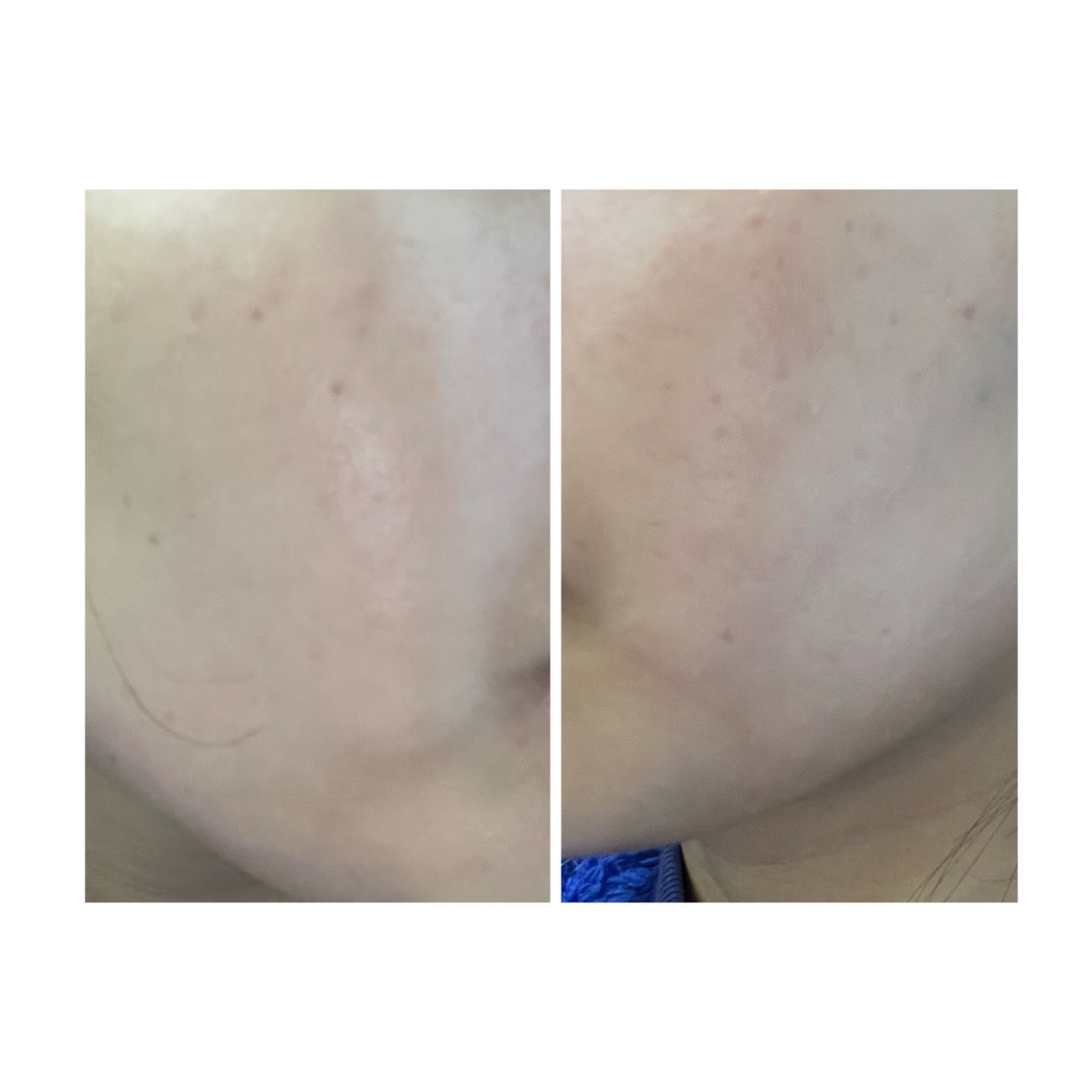 ぽむ on LIPS 「2023.9.13皮膚科に受診 エピデュオとヘパリン処方1枚目..」(3枚目)