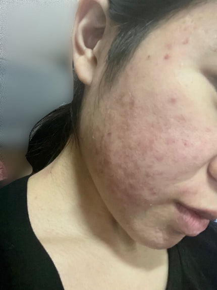 なぁな on LIPS 「お久しぶりです!皮膚科の薬を使用してから約2ヶ月が経ちます。以..」(3枚目)