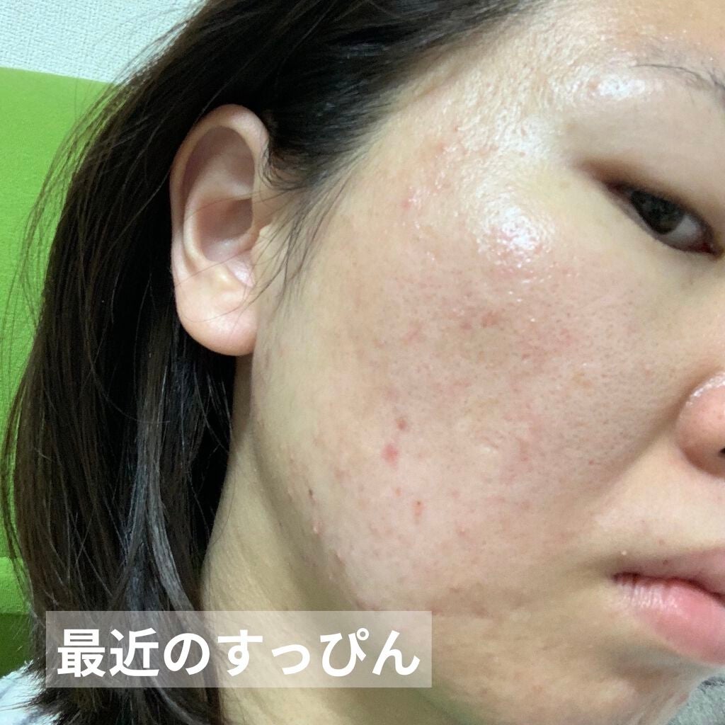 薬用 しみ 集中対策 美容液/メラノCC/美容液を使ったクチコミ(8枚目)