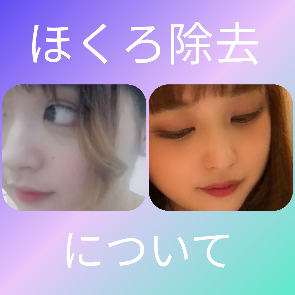 しるきー on LIPS 「【1万円以下でほくろ除去✨】お久しぶりになってしまいました🥺し..」(1枚目)