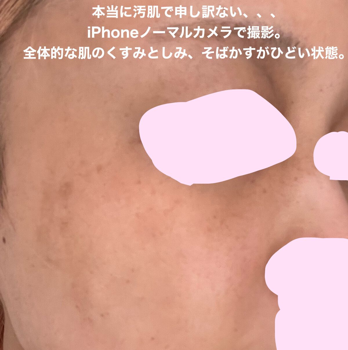 ダーマスキンピーリング/BQCELL/その他キットセットを使ったクチコミ（3枚目）