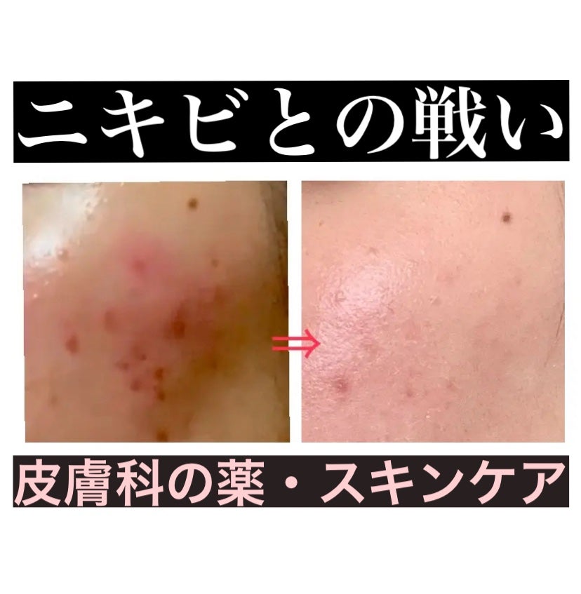 ACアクティブ モイスチュアミルク/NOV/乳液を使ったクチコミ(1枚目)