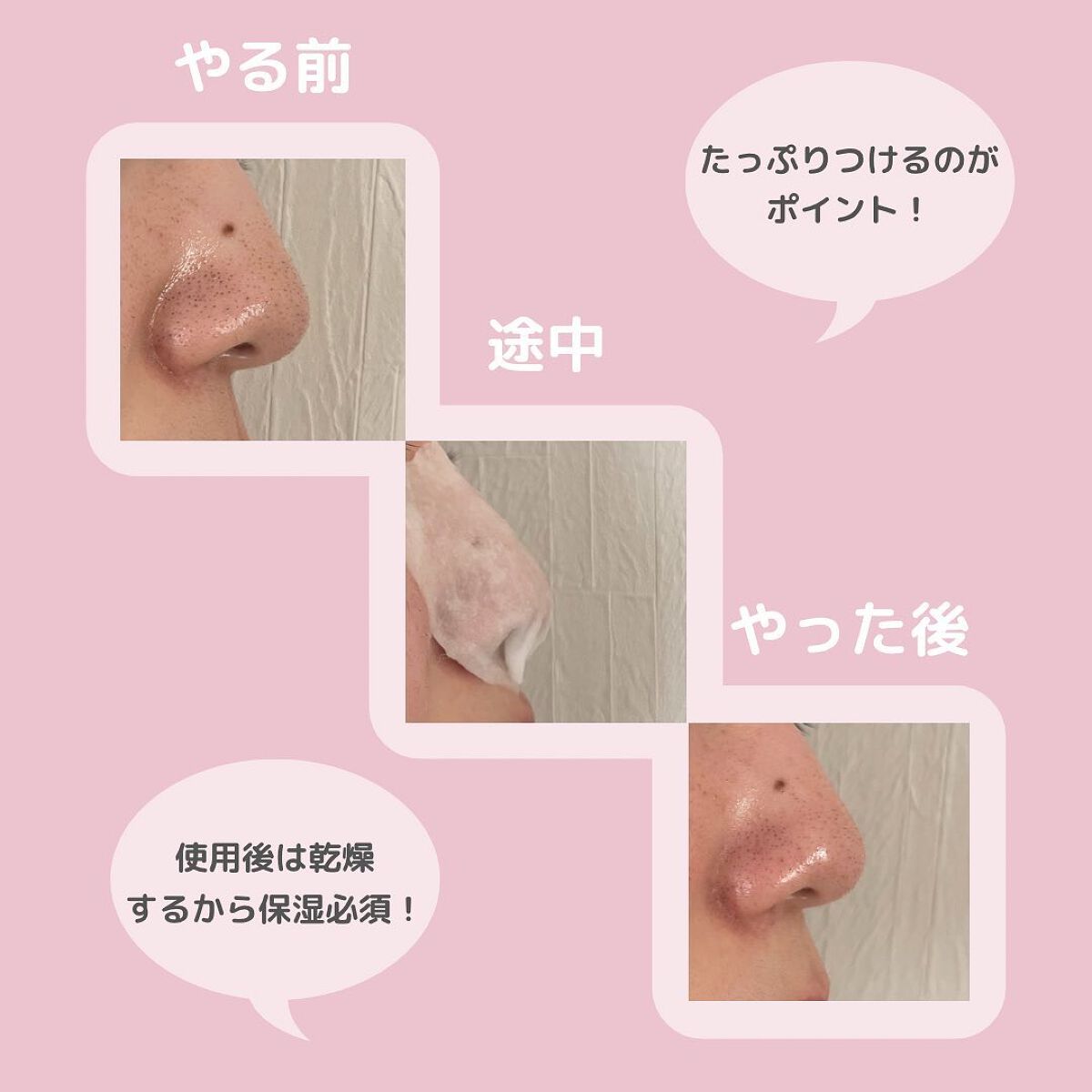 アクレオンセボエクストラクター/ANACIS/その他スキンケアを使ったクチコミ（3枚目）