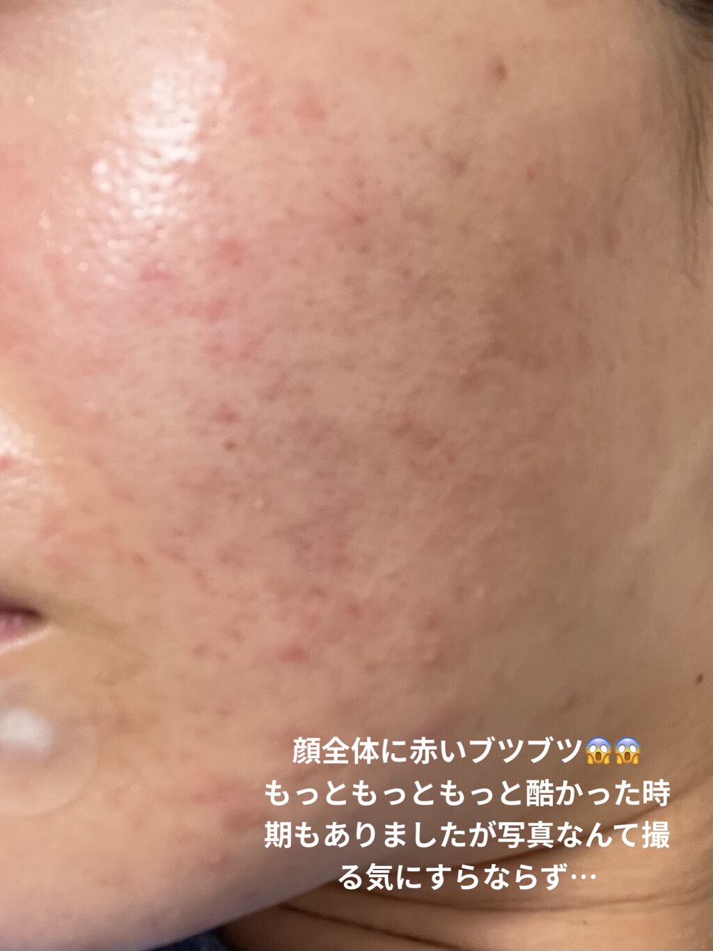 モイスチュア ローション/カルテHD/化粧水を使ったクチコミ（2枚目）