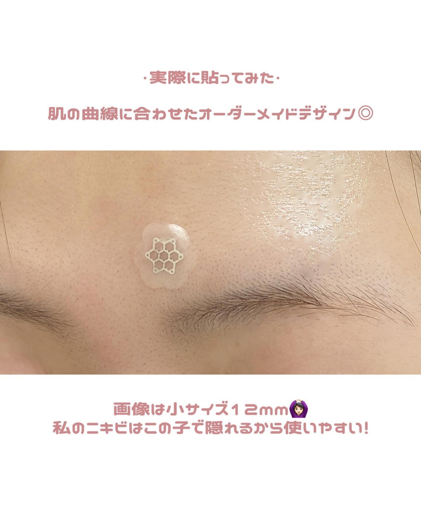 ACマグネシウムパッチ ミニ/スノーツープラス/にきびパッチを使ったクチコミ(4枚目)