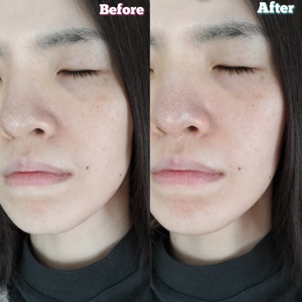 アキュネ 薬用ふきとりローションU/アキュネ/拭き取り化粧水を使ったクチコミ(6枚目)