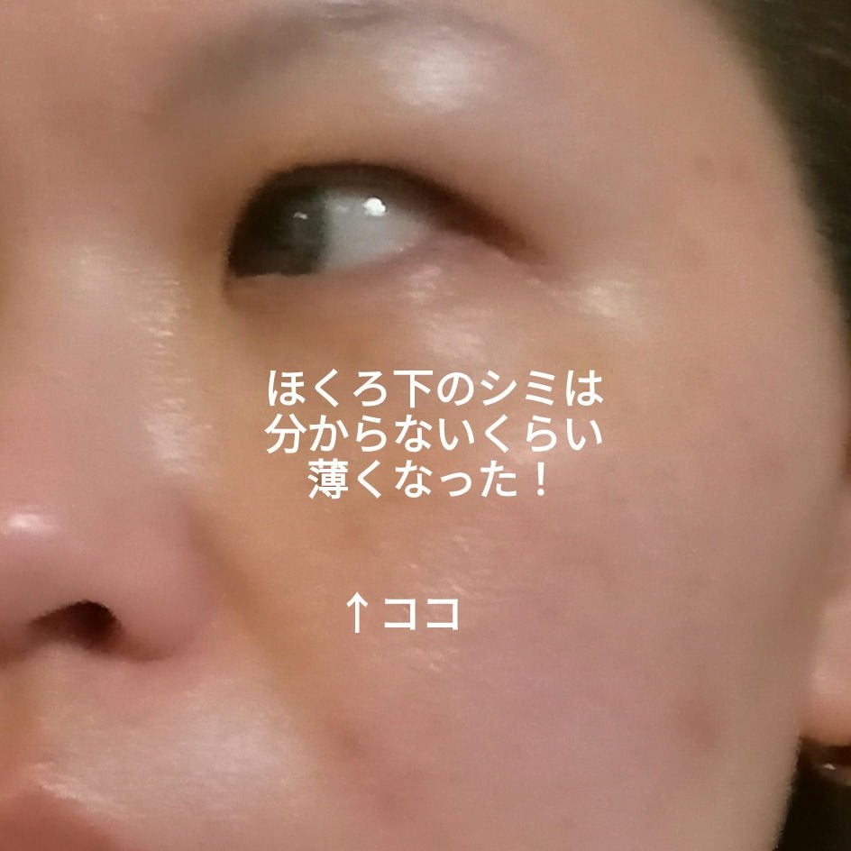 ビヨンセ奥二重向上委員長🥸LIPSパートナー🥳 on LIPS 「湘南美容IPL治療 フォトダブル4回目の1週間経過後の写真です..」(2枚目)