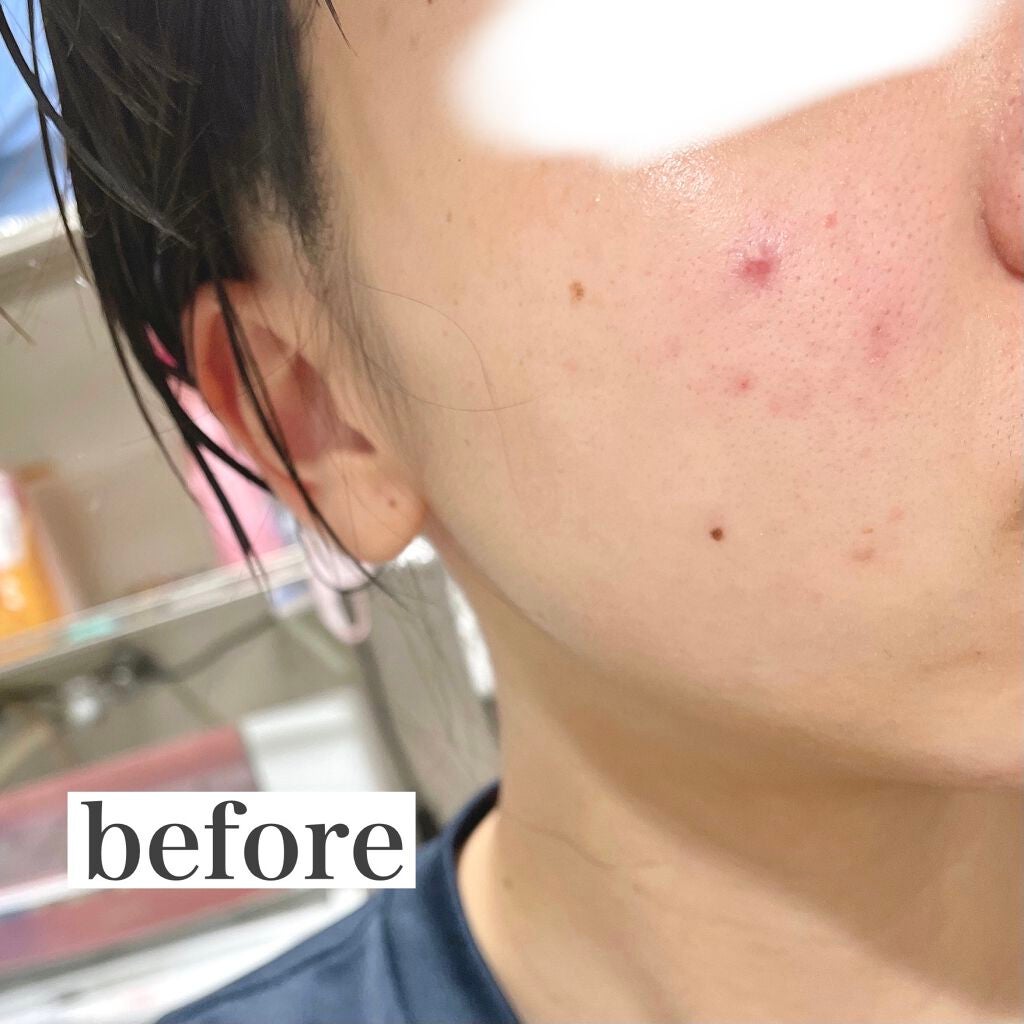 高濃度炭酸パック/17skin/シートマスク・パックを使ったクチコミ(4枚目)