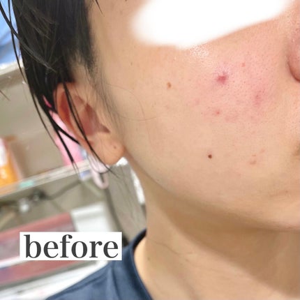 高濃度炭酸パック/17skin/シートマスク・パックを使ったクチコミ(4枚目)