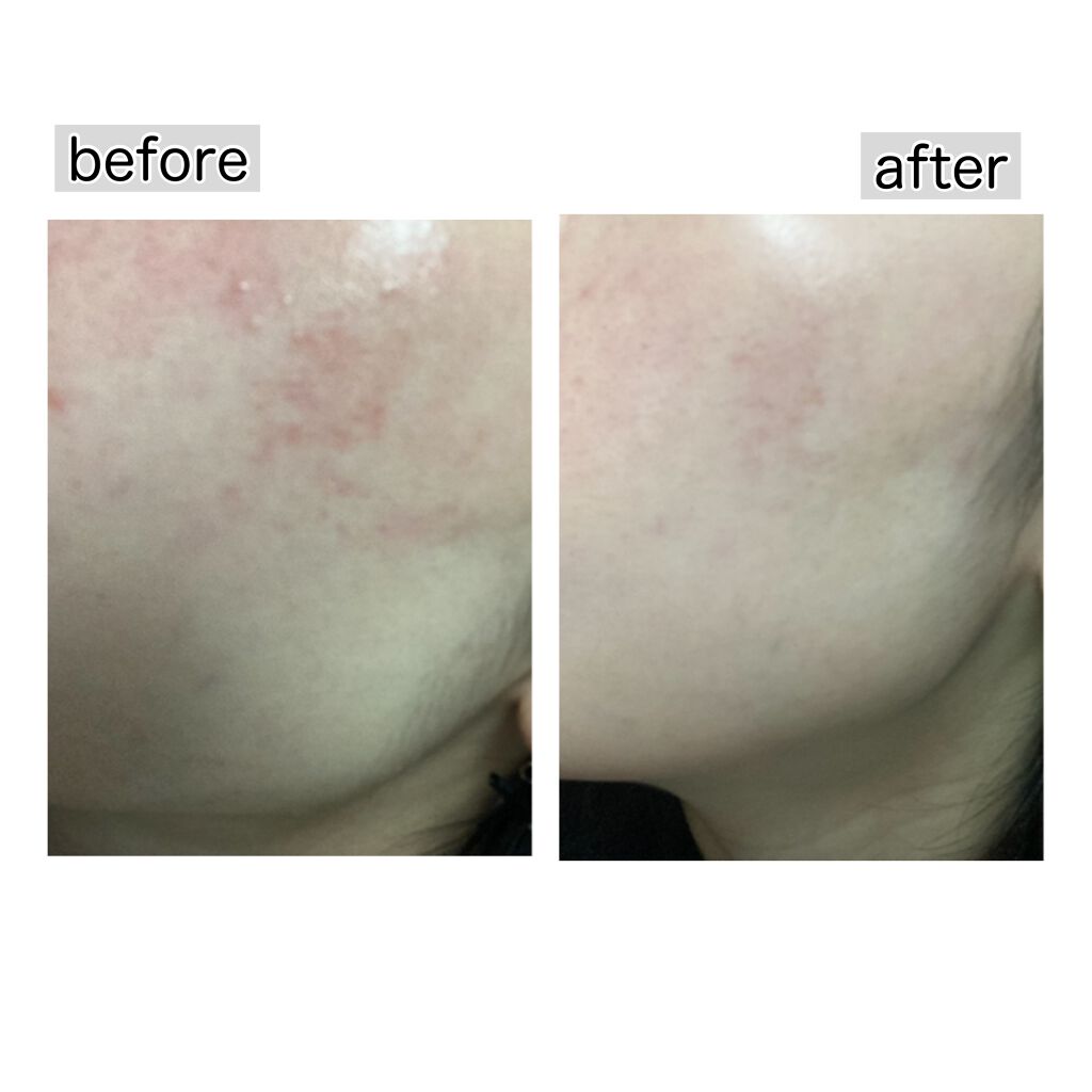 弱酸性レッドブレミッシュクリアスージングフォーム/Dr.G/洗顔フォームを使ったクチコミ(4枚目)