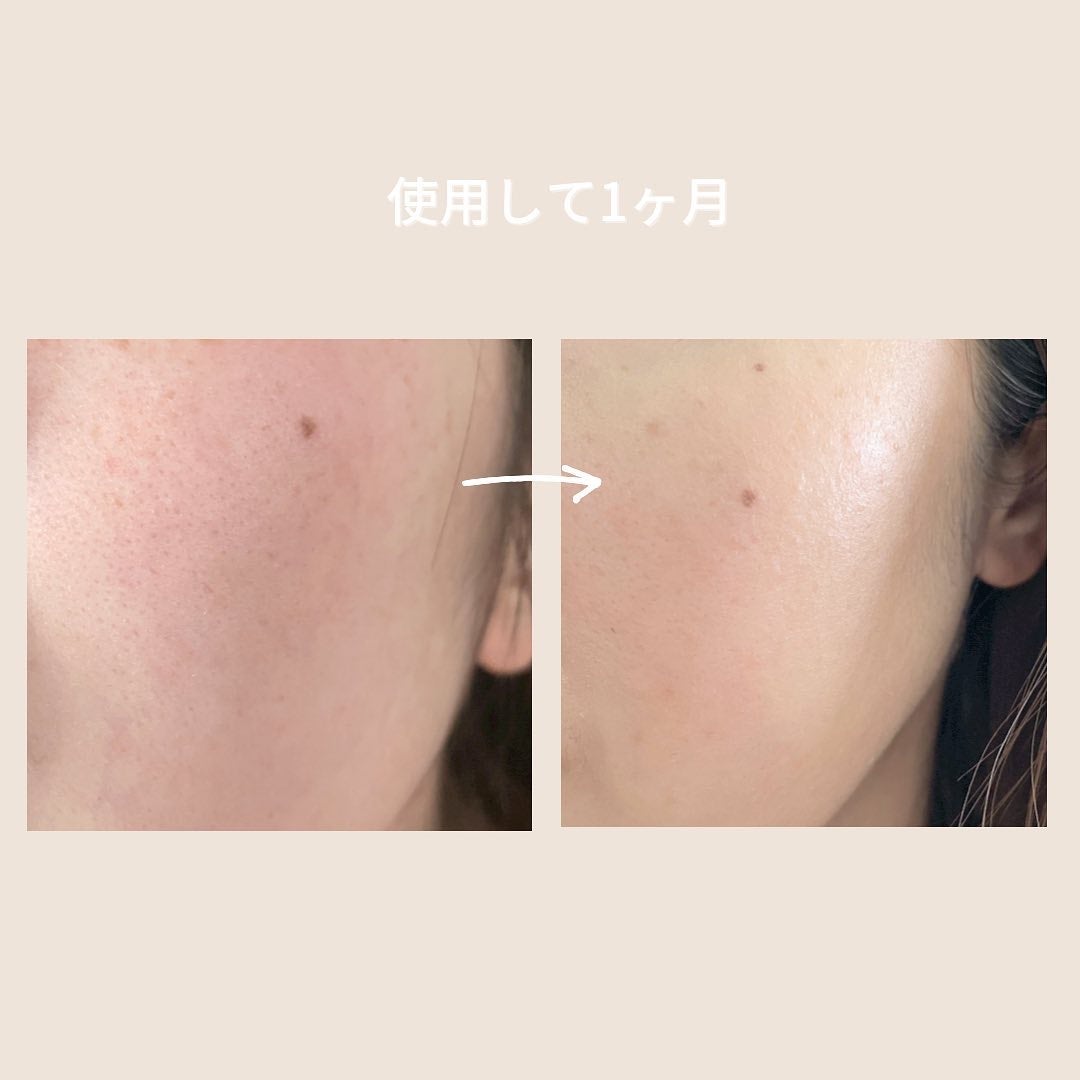 シカレチA エッセンス0.1/VT/美容液を使ったクチコミ(6枚目)