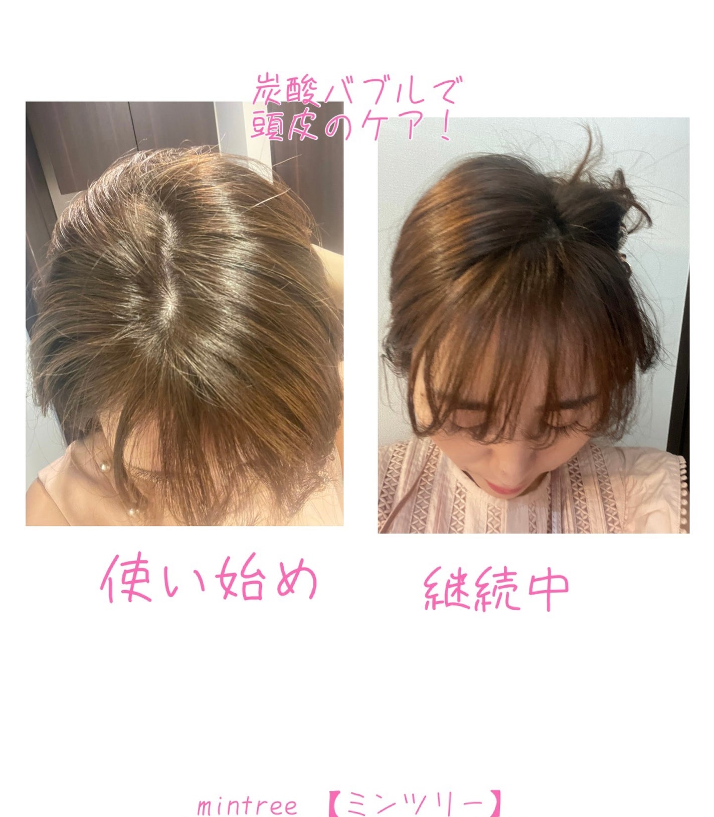 スパークリングスカルプスケーラー/ミンツリー/頭皮ケアを使ったクチコミ(3枚目)