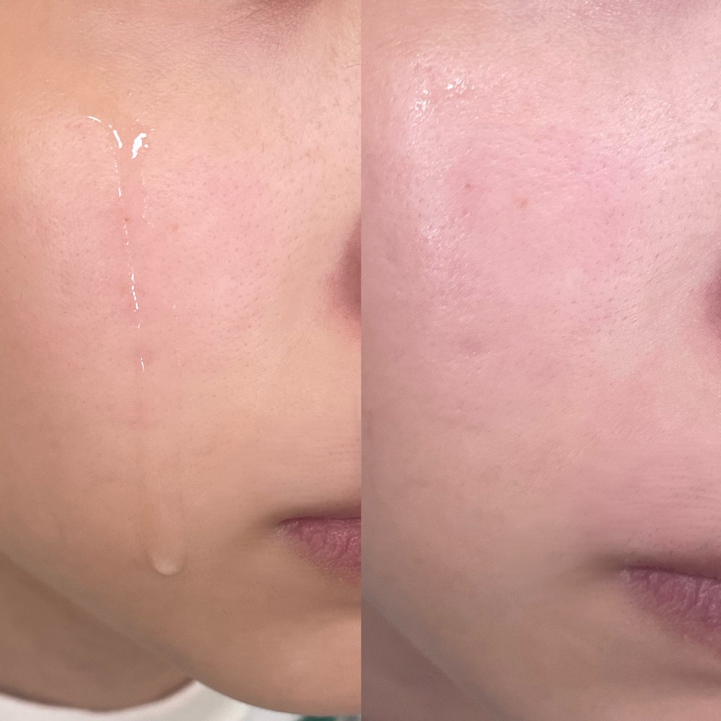 エファクラ ピールケア セラム/ラ ロッシュ ポゼ/美容液を使ったクチコミ(3枚目)