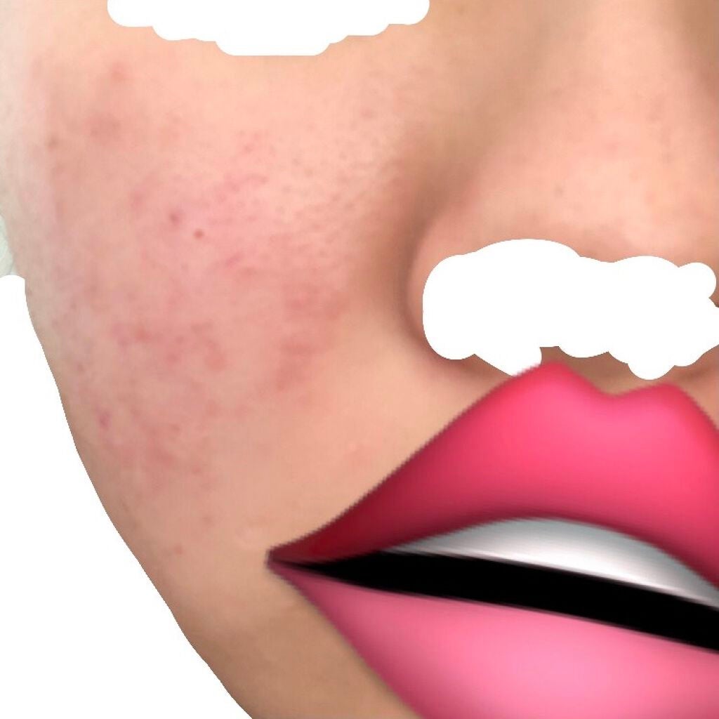 ðåã«ãªããã女ã®å on LIPS ããèã®æ©ã¿ã§ãð§ãããããããŸããããããè·¡ãèµ€ã¿ã錻ã®é»ãã¿..ãïŒ3æç®ïŒ