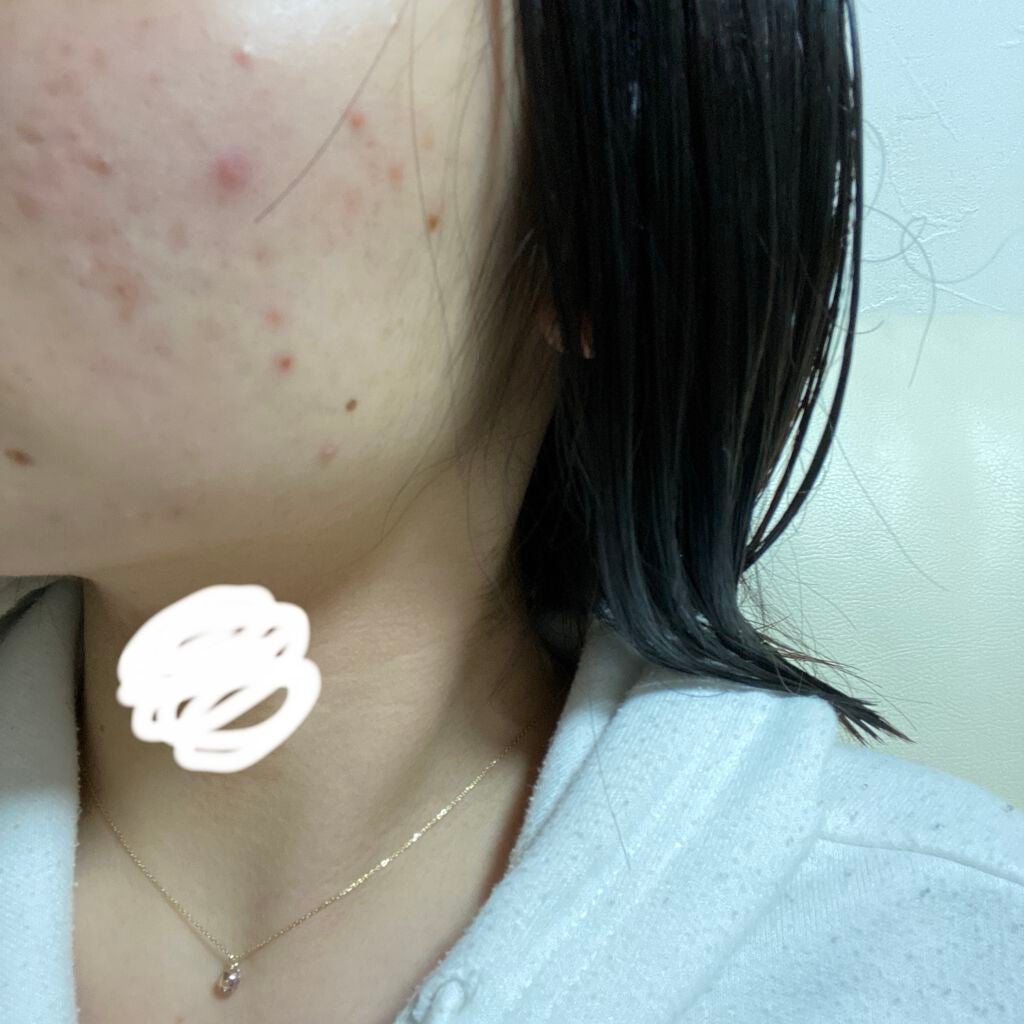 あちもち on LIPS 「私のニキビ肌、助けてください。初めまして!あちもちです!!私の..」(1枚目)