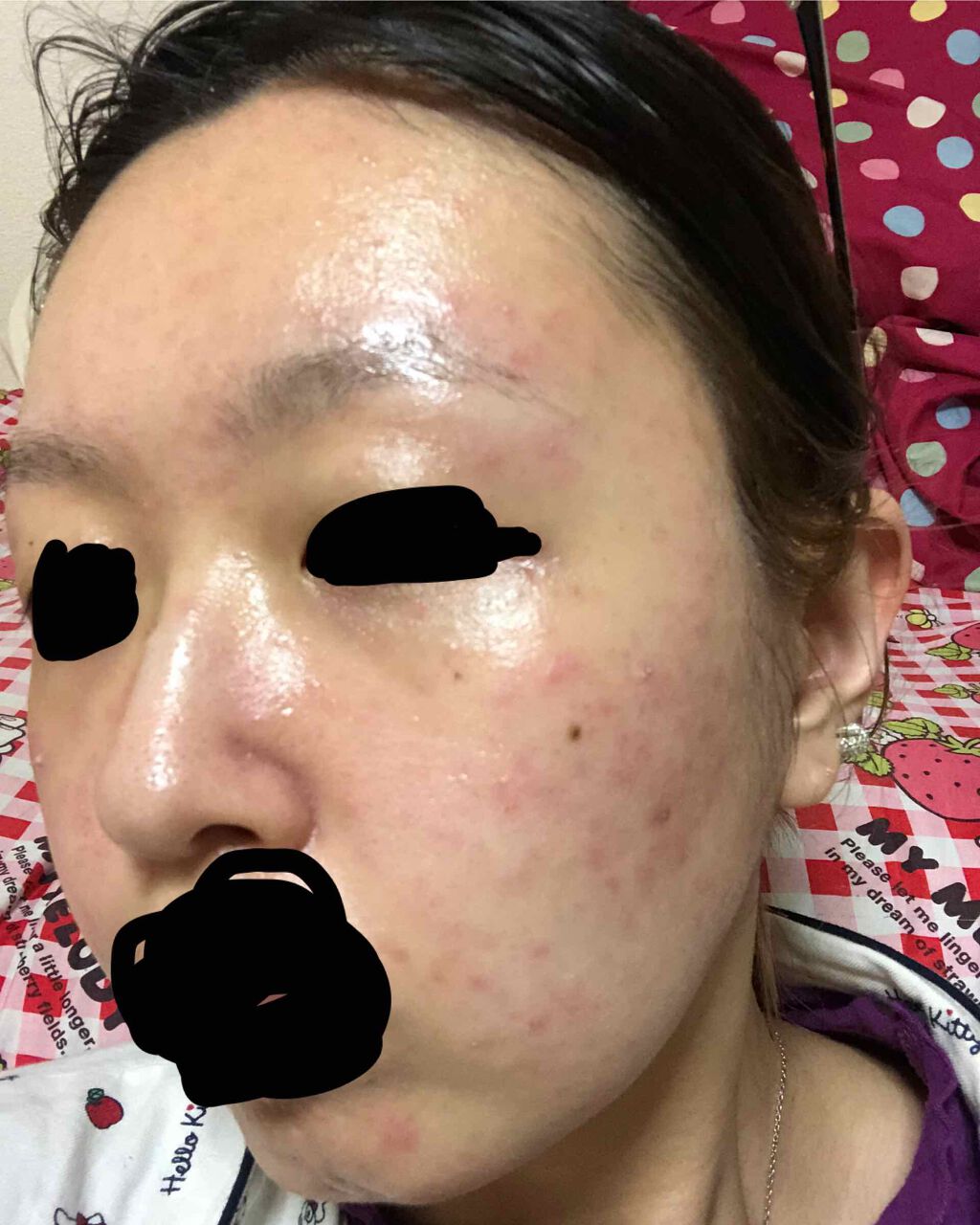 Sparksound on LIPS 「肌荒れメモなかなか治らないから皮膚科に行ったとくに薬は無く朝洗..」(1枚目)