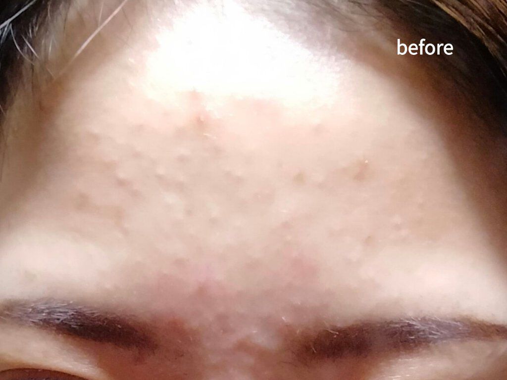 ペアアクネクリームW(医薬品)/ペア/その他を使ったクチコミ（2枚目）