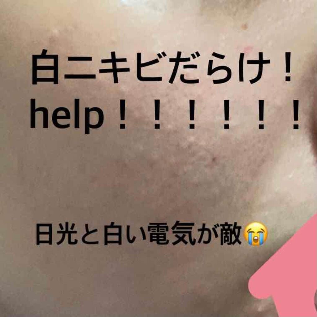 クラーク on LIPS 「赤ニキビは皮膚科でもらった薬でなんとかこの感じですが全く治りま..」(1枚目)