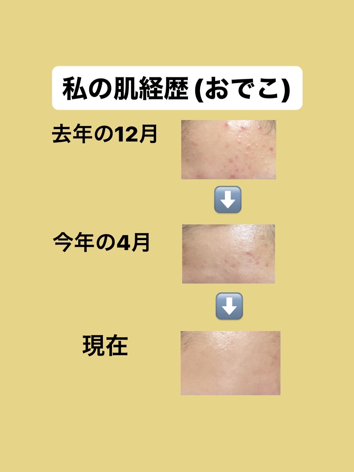 パーフェクトホイップ アクネケア/SENKA（専科）/洗顔フォームを使ったクチコミ（2枚目）