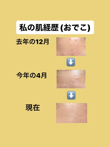 パーフェクトホイップ アクネケア/SENKA(専科)/洗顔フォームを使ったクチコミ(2枚目)