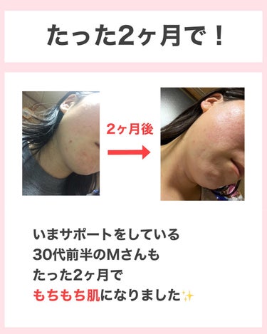 タクミ【ニキビケアサポーター】 on LIPS 「@nikibi_takumi173乾燥肌の女子大生に向けてニキ..」（9枚目）