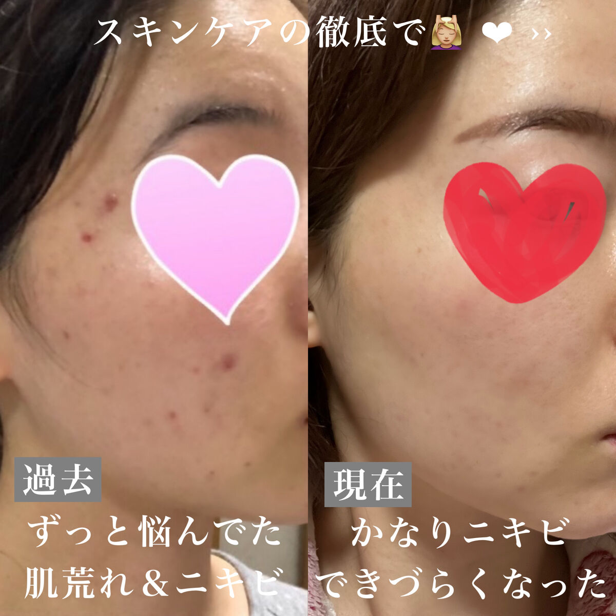 ブライトクリーン/YA-MAN TOKYO JAPAN/美顔器・マッサージを使ったクチコミ（2枚目）