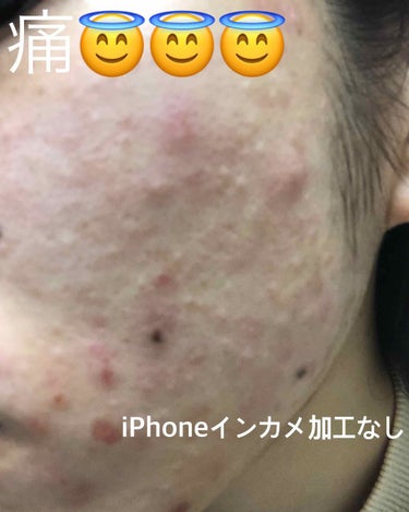 twinkle_cosme_rnn on LIPS 「まじで顔面が痛すぎる、アレルギーが目鼻だけでは飽き足らずもれな..」（2枚目）