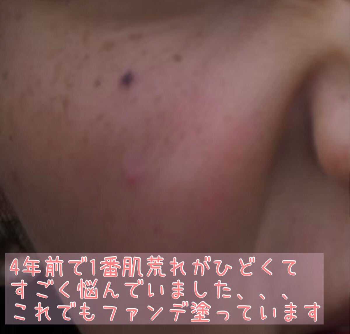こはる☆フォロバ on LIPS 「・・・肌トラブル過多の私が褒められ肌になるまでの過程!写真は全..」(2枚目)