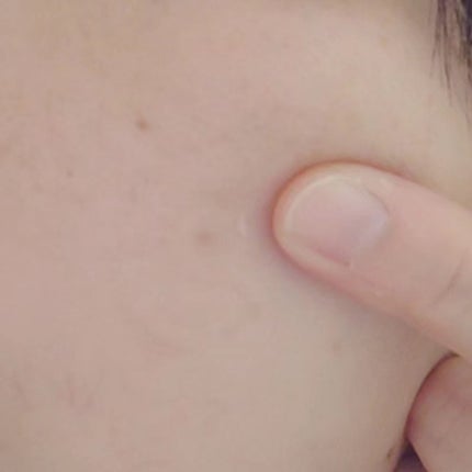 ビューティー スポットパッチ/イージーダムビューティー/にきびパッチを使ったクチコミ(6枚目)