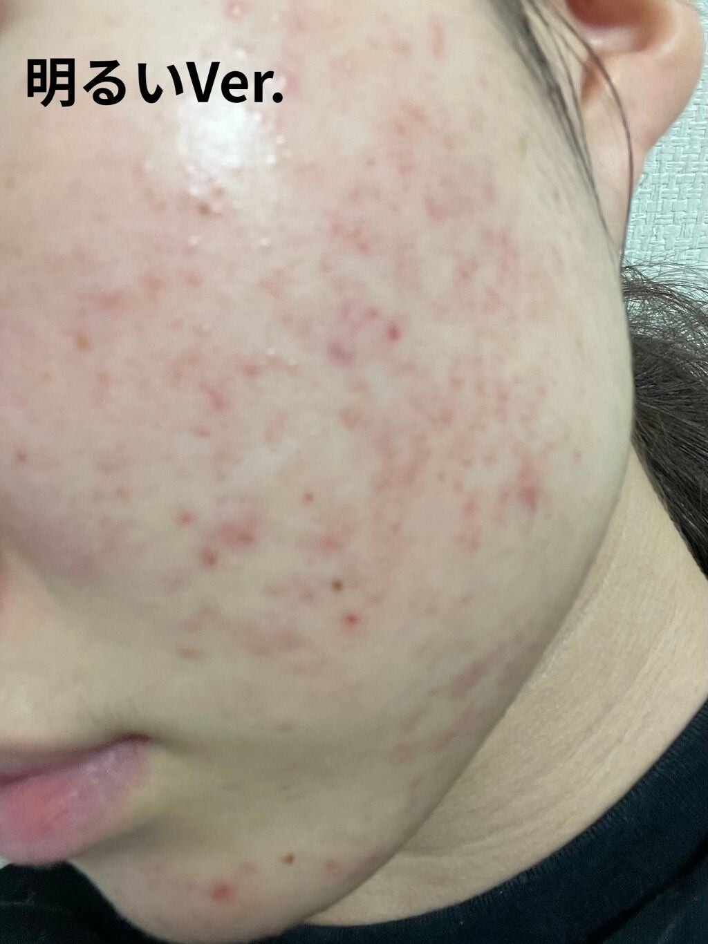 バイオイル/バイオイル/フェイスオイルを使ったクチコミ(3枚目)