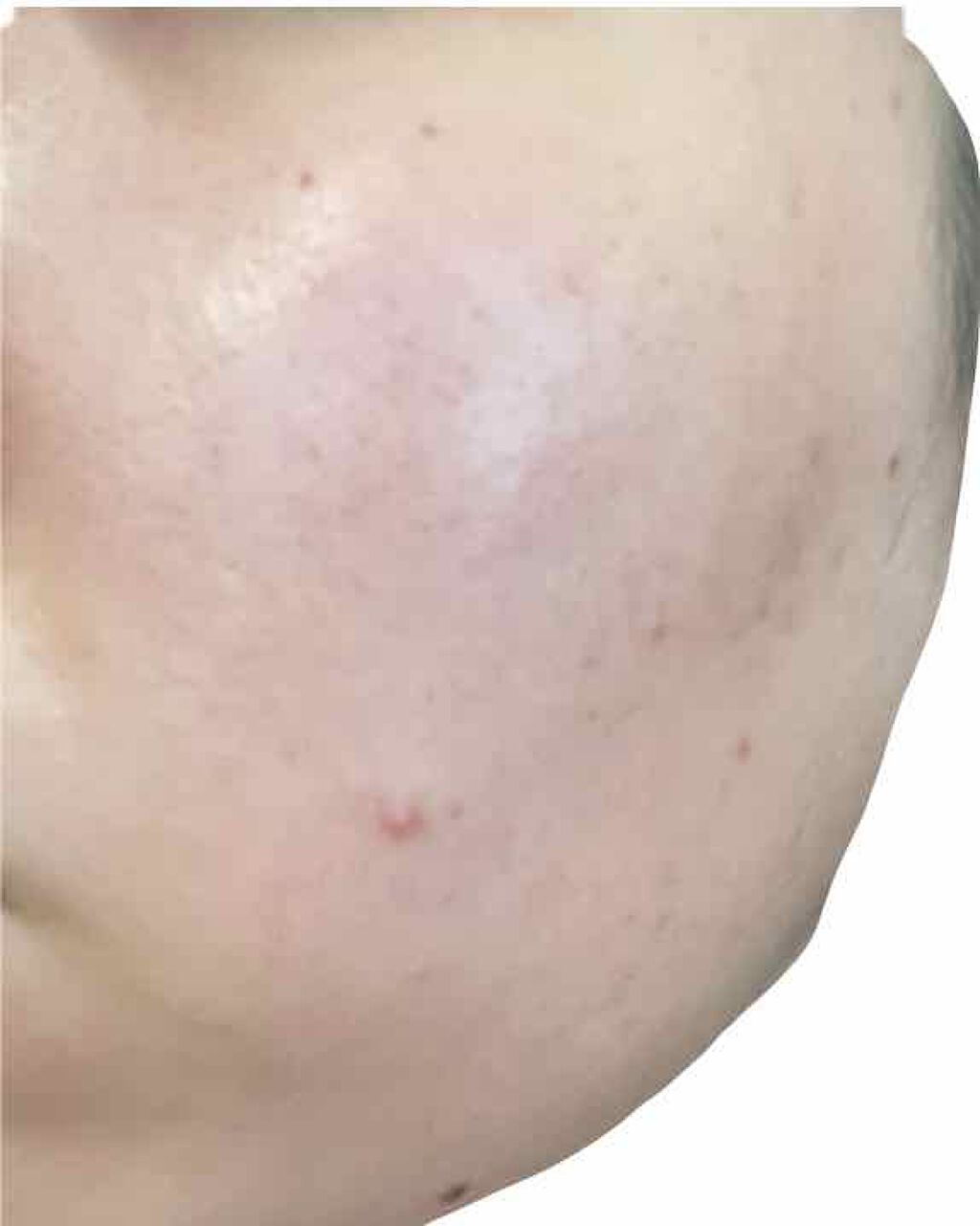 ベピオゲル/マルホ株式会社/その他を使ったクチコミ（3枚目）