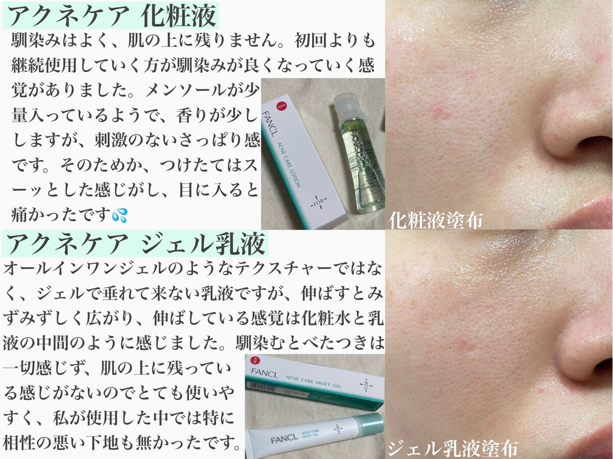アクネケア 化粧液　＜医薬部外品＞/ファンケル/化粧水を使ったクチコミ（2枚目）