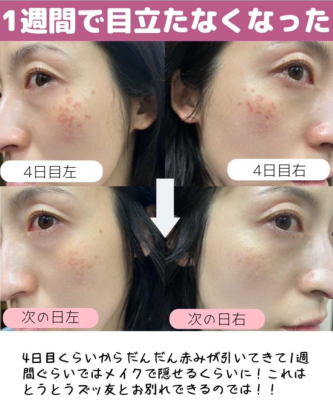 miisa/歳を重ねても"可愛い"をつくる美容法 on LIPS 「\悲しみ💔/そばかす取ったら衝撃の結末🫨𓇠𓇠𓇠𓇠𓇠𓇠𓇠𓇠𓇠𓇠𓇠..」(6枚目)